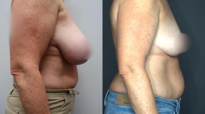 Breast Reduction, Right Photo, Calgary Alberta, Demsey Plastic Surgery 