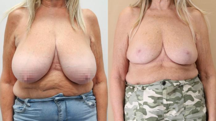 Breast Reduction, Front Photo, Calgary Alberta, Demsey Plastic Surgery 