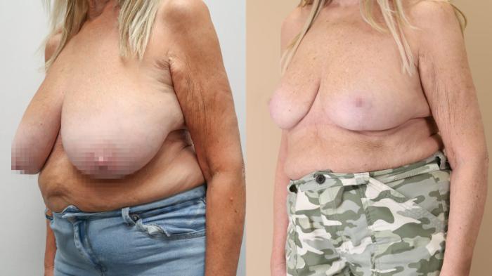 Breast Reduction, Left Oblique Photo, Calgary Alberta, Demsey Plastic Surgery 