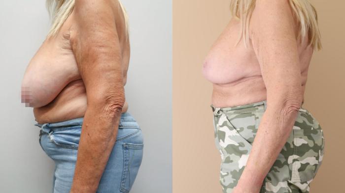 Breast Reduction, Left Side Photo, Calgary Alberta, Demsey Plastic Surgery 