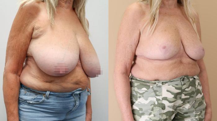 Augmentation, Right Oblique Photo, Calgary Alberta, Demsey Plastic Surgery 
