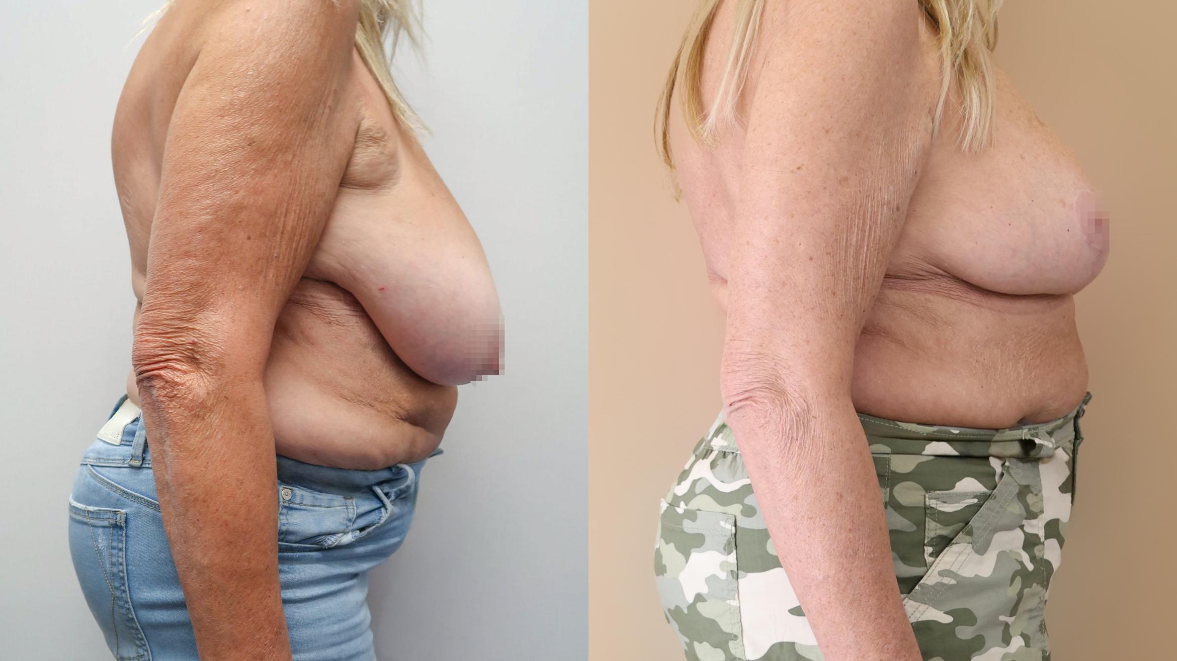 Breast Reduction, Right Side Photo, Calgary Alberta, Demsey Plastic Surgery 
