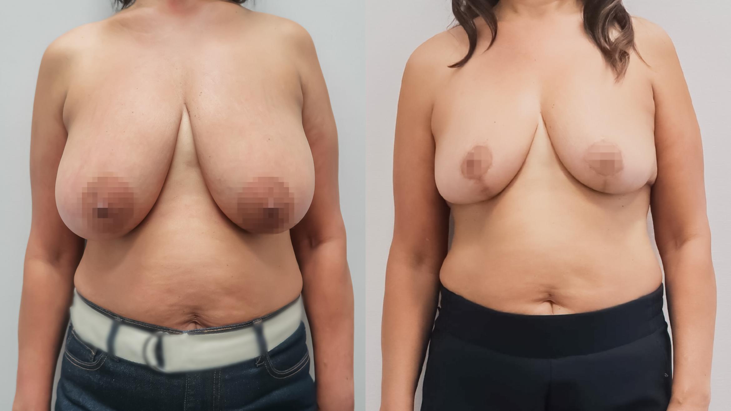 Breast Reduction, Front Photo, Calgary Alberta, Demsey Plastic Surgery 