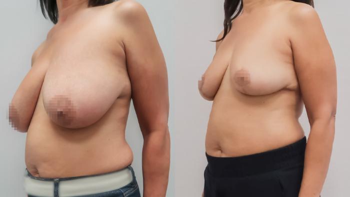 Breast Reduction, Left Oblique Photo, Calgary Alberta, Demsey Plastic Surgery 