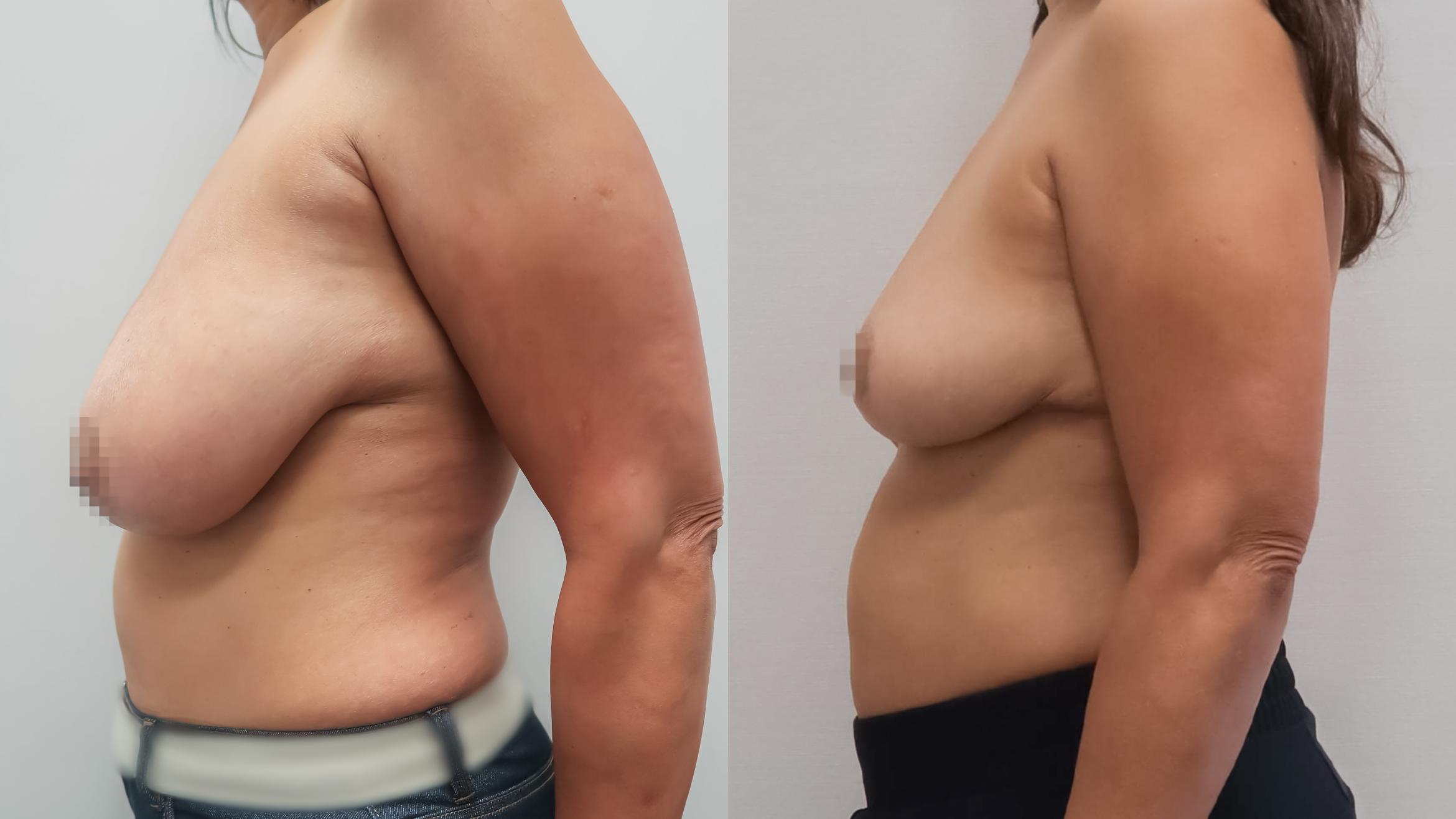 Breast Reduction, Left Side Photo, Calgary Alberta, Demsey Plastic Surgery 