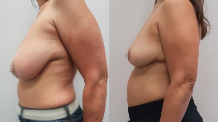 Breast Reduction, Left Side Photo, Calgary Alberta, Demsey Plastic Surgery 