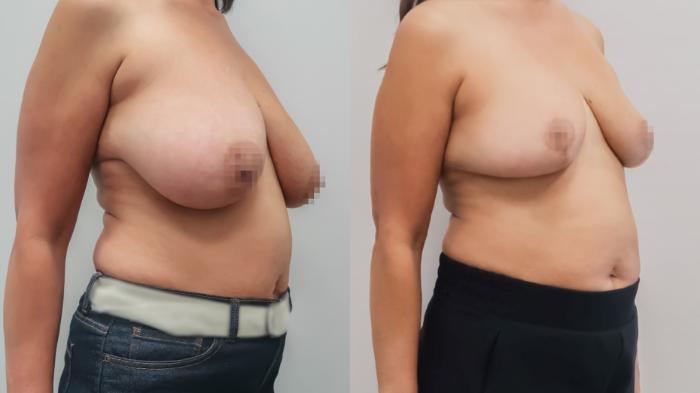 Breast Reduction, Right Oblique Photo, Calgary Alberta, Demsey Plastic Surgery 