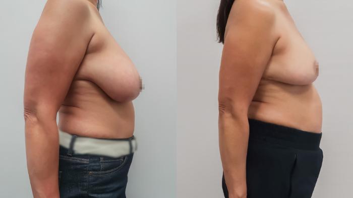 Breast Reduction, Right Side Photo, Calgary Alberta, Demsey Plastic Surgery 
