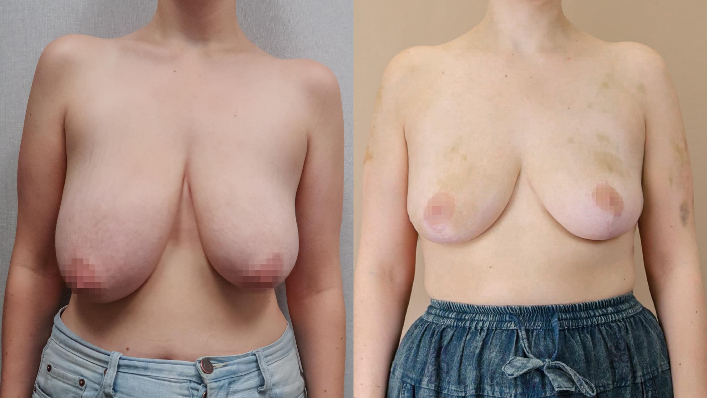 Breast Reduction, Front Photo, Calgary Alberta, Demsey Plastic Surgery 