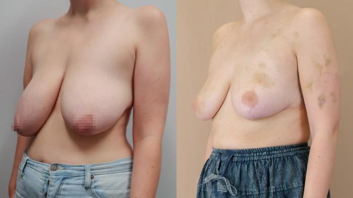Breast Reduction, Left Oblique Photo, Calgary Alberta, Demsey Plastic Surgery 