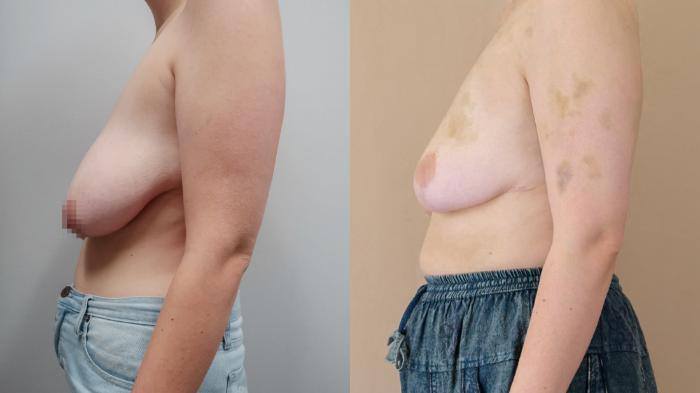 Breast Reduction, Left Side Photo, Calgary Alberta, Demsey Plastic Surgery 