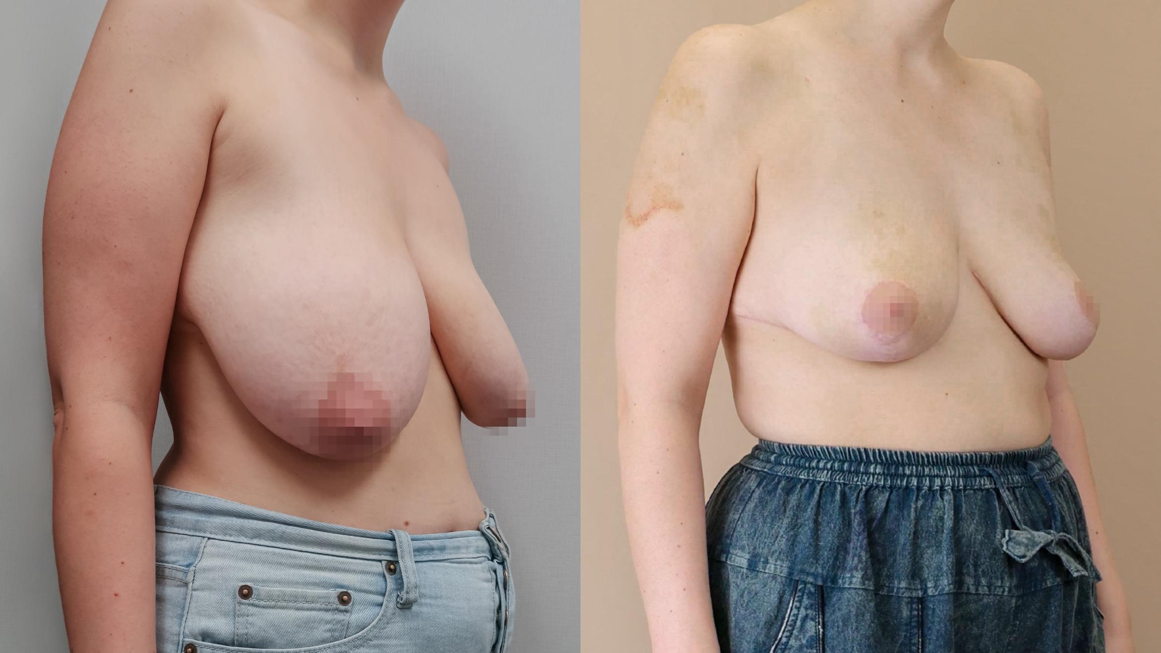 Breast Reduction, Right Oblique Photo, Calgary Alberta, Demsey Plastic Surgery 