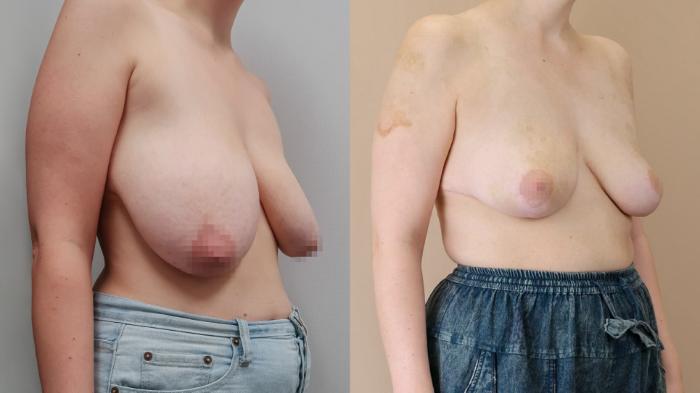Breast Reduction, Right Oblique Photo, Calgary Alberta, Demsey Plastic Surgery 