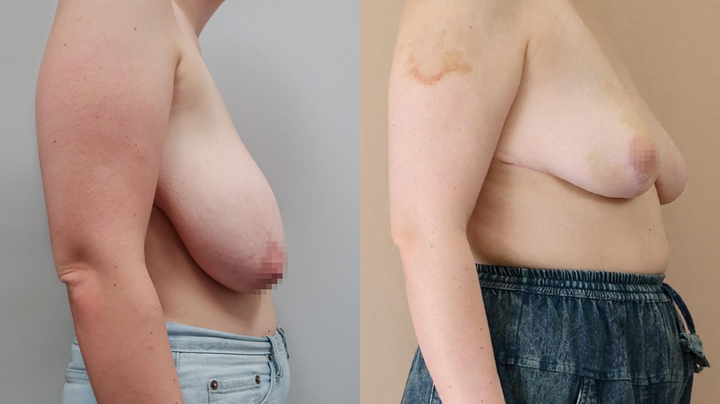 Breast Reduction, Right Side Photo, Calgary Alberta, Demsey Plastic Surgery 