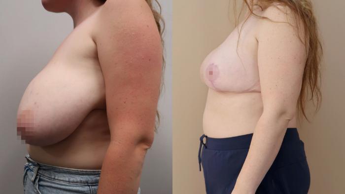 Breast Reduction, Left Side Photo, Calgary Alberta, Demsey Plastic Surgery 