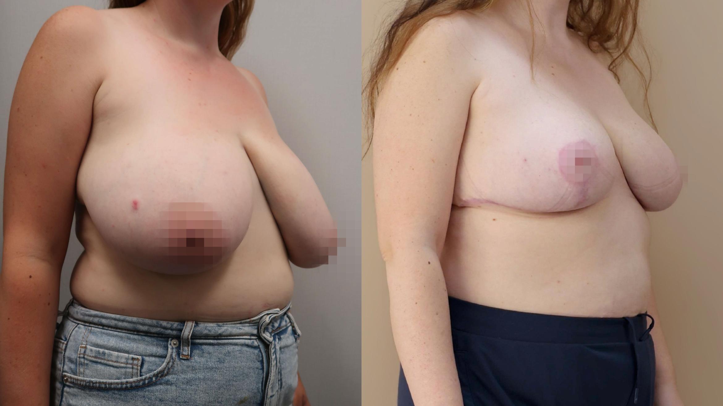 Breast Reduction, Right Oblique Photo, Calgary Alberta, Demsey Plastic Surgery 
