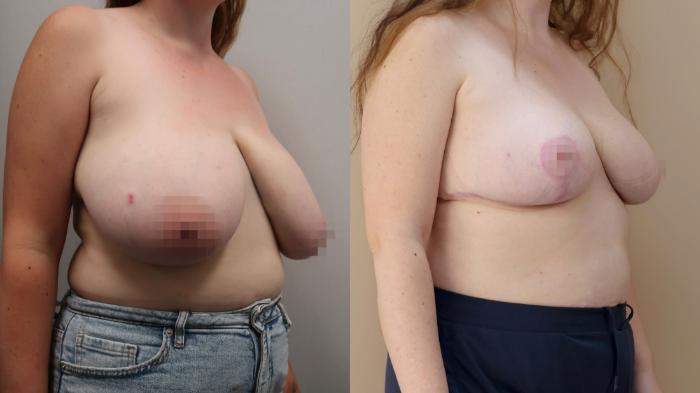 Breast Reduction, Right Oblique Photo, Calgary Alberta, Demsey Plastic Surgery 