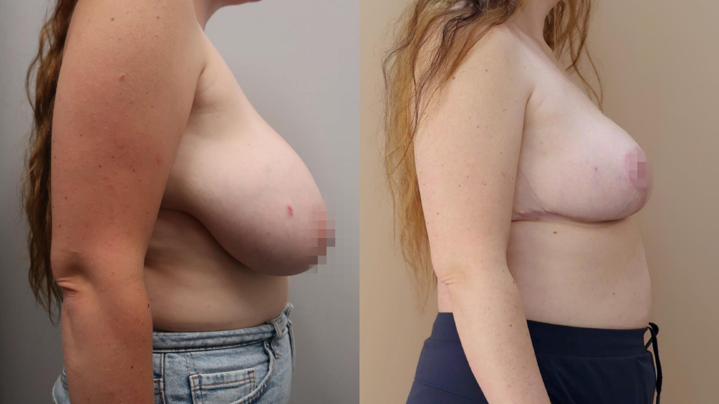Breast Reduction, Right Photo, Calgary Alberta, Demsey Plastic Surgery 