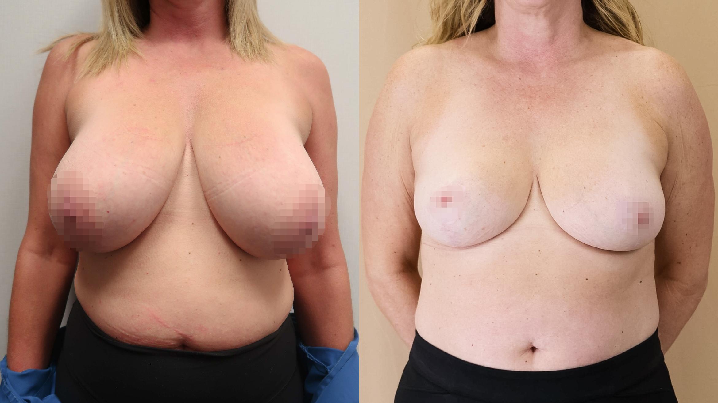 Before & After Breast Reduction Case 23 Front View in Calgary, Alberta