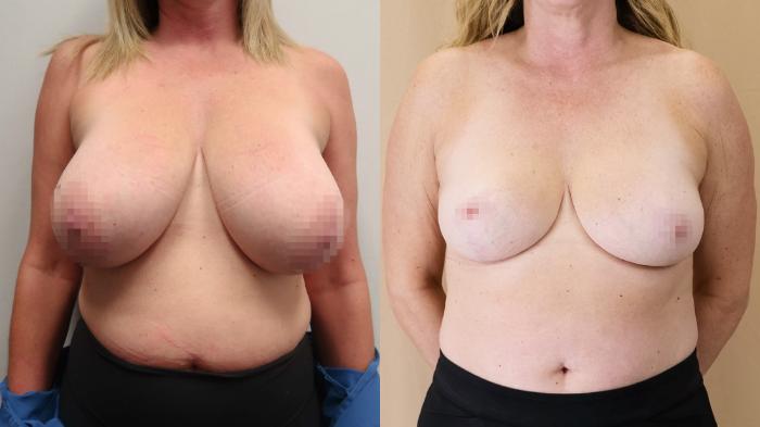 Before & After Breast Reduction Case 23 Front View in Calgary, Alberta