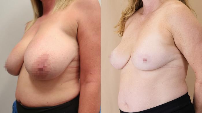 Before & After Breast Reduction Case 23 Left Oblique View in Calgary, Alberta