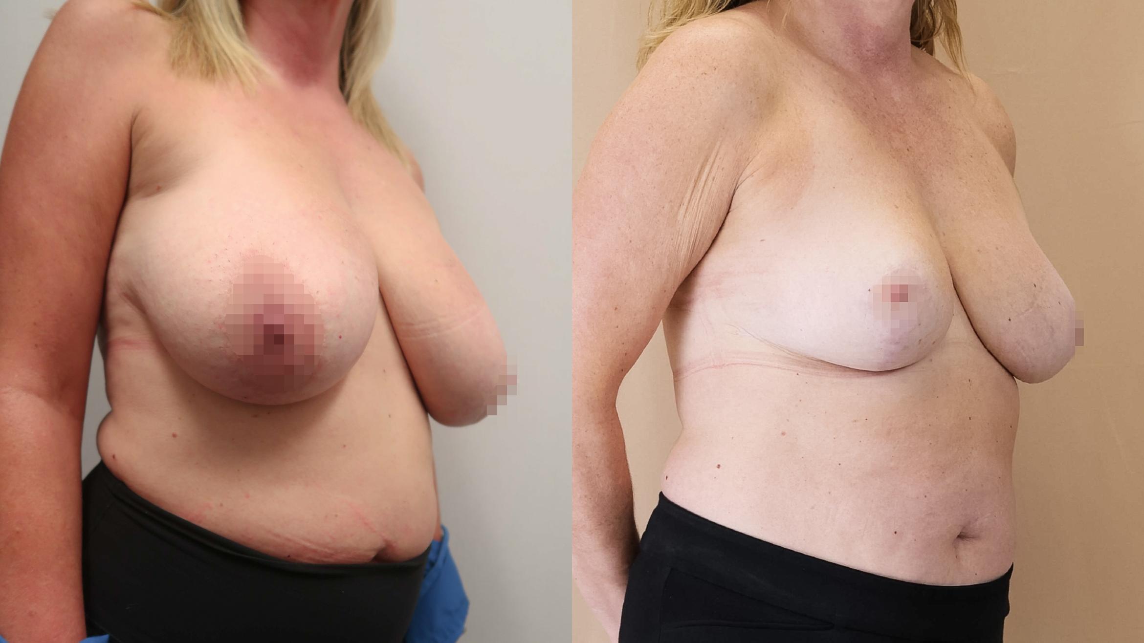Before & After Breast Reduction Case 23 Right Oblique View in Calgary, Alberta