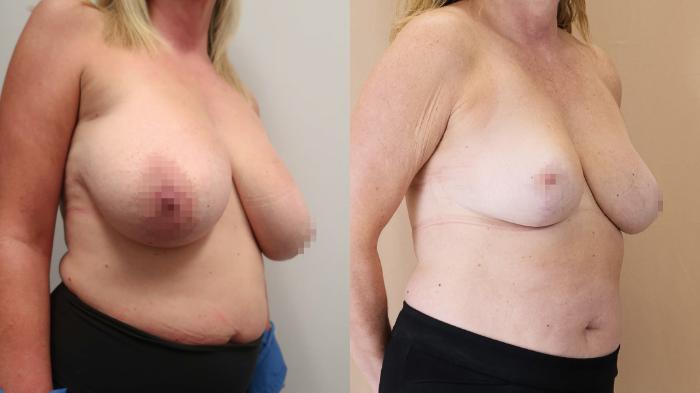 Before & After Breast Reduction Case 23 Right Oblique View in Calgary, Alberta