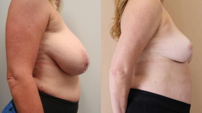 Before & After Breast Reduction Case 23 Right Side View in Calgary, Alberta