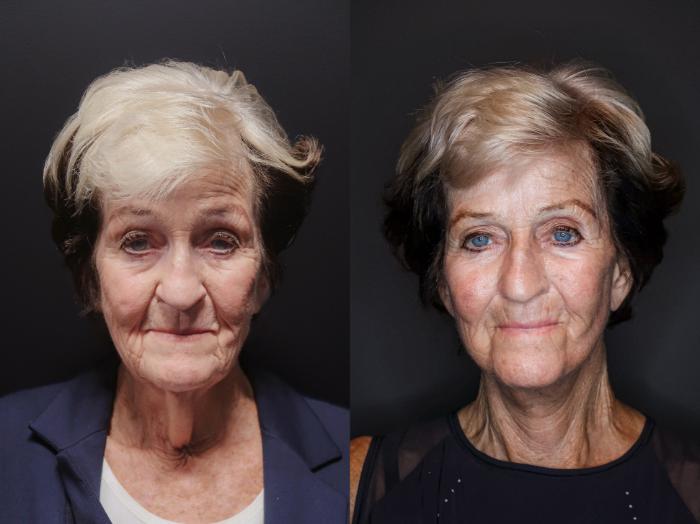 Facelift, Front Photo, Calgary Alberta, Demsey Plastic Surgery 