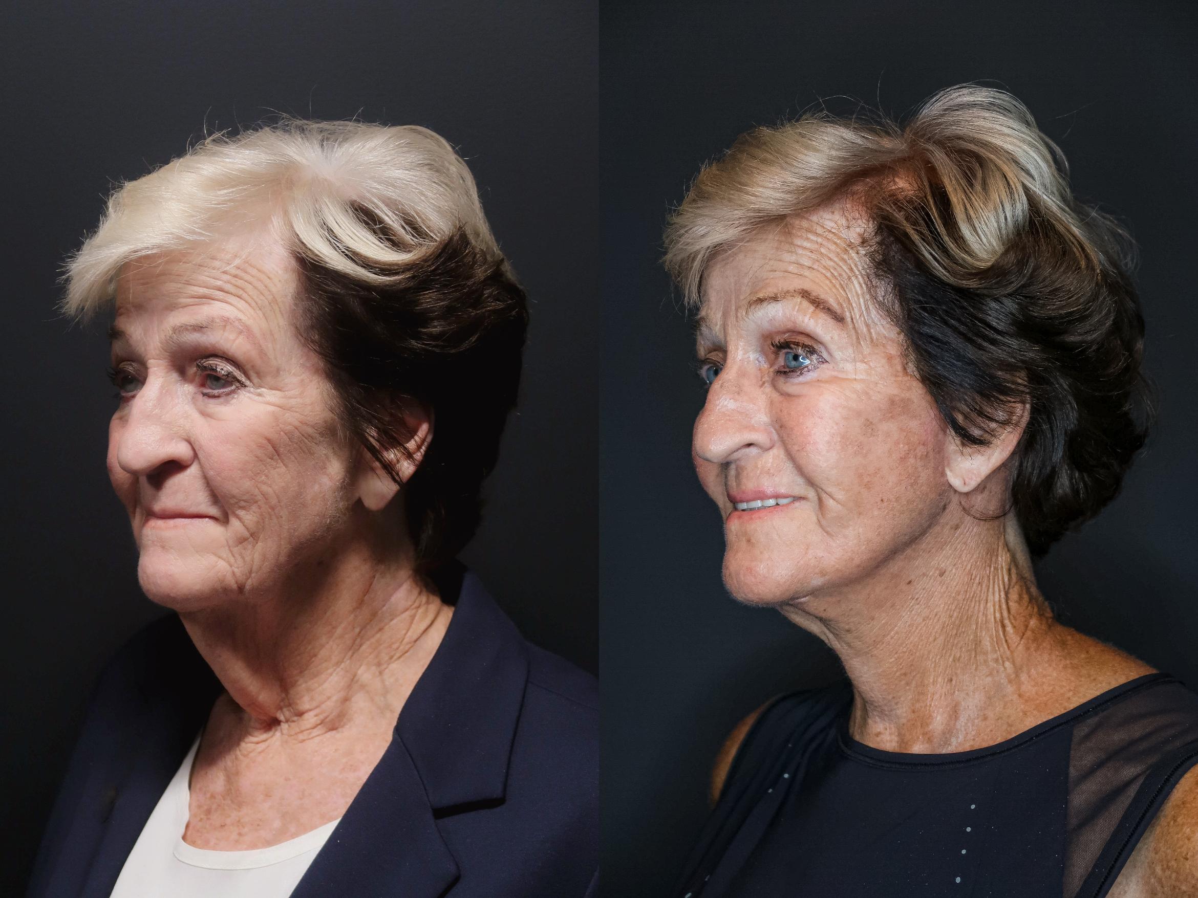 Facelift, Left Oblique Photo, Calgary Alberta, Demsey Plastic Surgery 