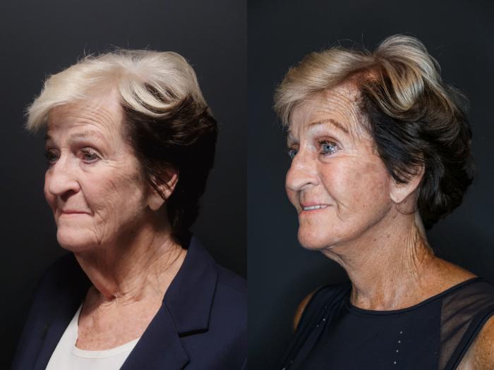 Facelift, Left Oblique Photo, Calgary Alberta, Demsey Plastic Surgery 