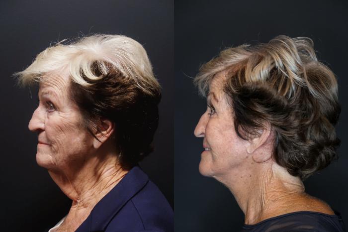 Facelift, Left Side Photo, Calgary Alberta, Demsey Plastic Surgery 