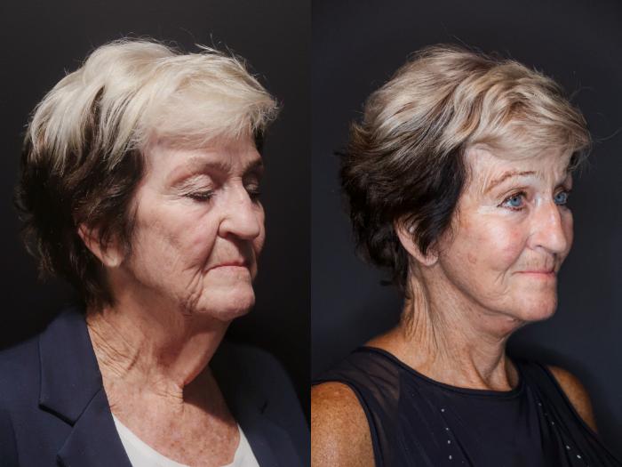 Facelift, Right Oblique Photo, Calgary Alberta, Demsey Plastic Surgery 