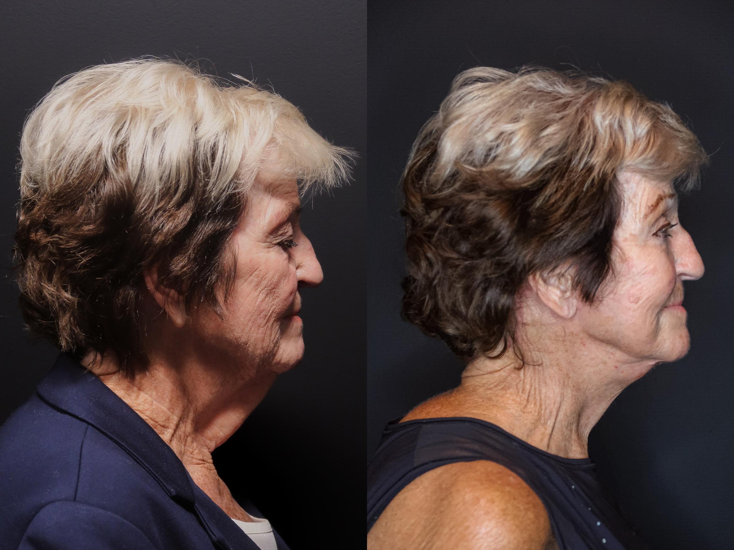 Facelift, Right Side Photo, Calgary Alberta, Demsey Plastic Surgery 