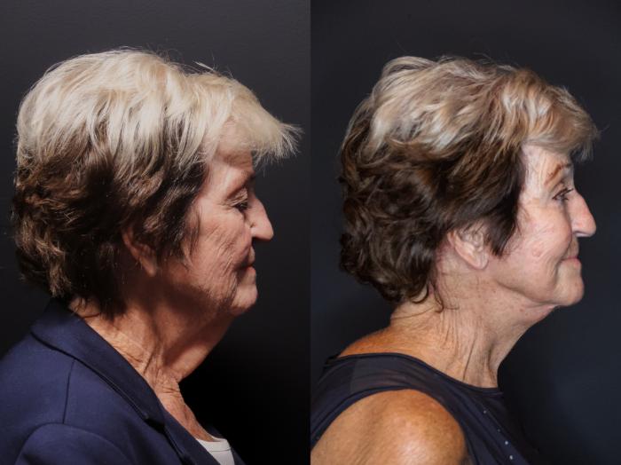 Facelift, Right Side Photo, Calgary Alberta, Demsey Plastic Surgery 